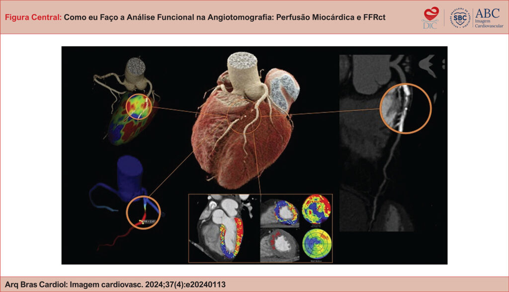 Angiotomografia coronariana aliando anatomia e avaliação funcional na pesquisa de doença coronariana. Painel central: reconstrução tridimensional do coração e artérias coronárias. Painel superior esquerdo: árvore coronariana 3D com mapa perfusional do ventrículo esquerdo demonstrando território irrigado pela artéria acometida. Painel inferior esquerdo: reserva de FFRct com valor < 0,80, compatível com estenose fluxo-limitante. Painel inferior: perfusão miocárdica codificada em cores, demonstrando defeito de perfusão sob estresse relacionado ao território da artéria DA. Painel direito: análise visual anatômica pela ACTC, demonstrando lesão suboclusiva em artéria DA.