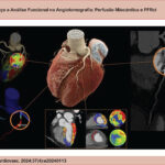 Angiotomografia coronariana aliando anatomia e avaliação funcional na pesquisa de doença coronariana. Painel central: reconstrução tridimensional do coração e artérias coronárias. Painel superior esquerdo: árvore coronariana 3D com mapa perfusional do ventrículo esquerdo demonstrando território irrigado pela artéria acometida. Painel inferior esquerdo: reserva de FFRct com valor < 0,80, compatível com estenose fluxo-limitante. Painel inferior: perfusão miocárdica codificada em cores, demonstrando defeito de perfusão sob estresse relacionado ao território da artéria DA. Painel direito: análise visual anatômica pela ACTC, demonstrando lesão suboclusiva em artéria DA.