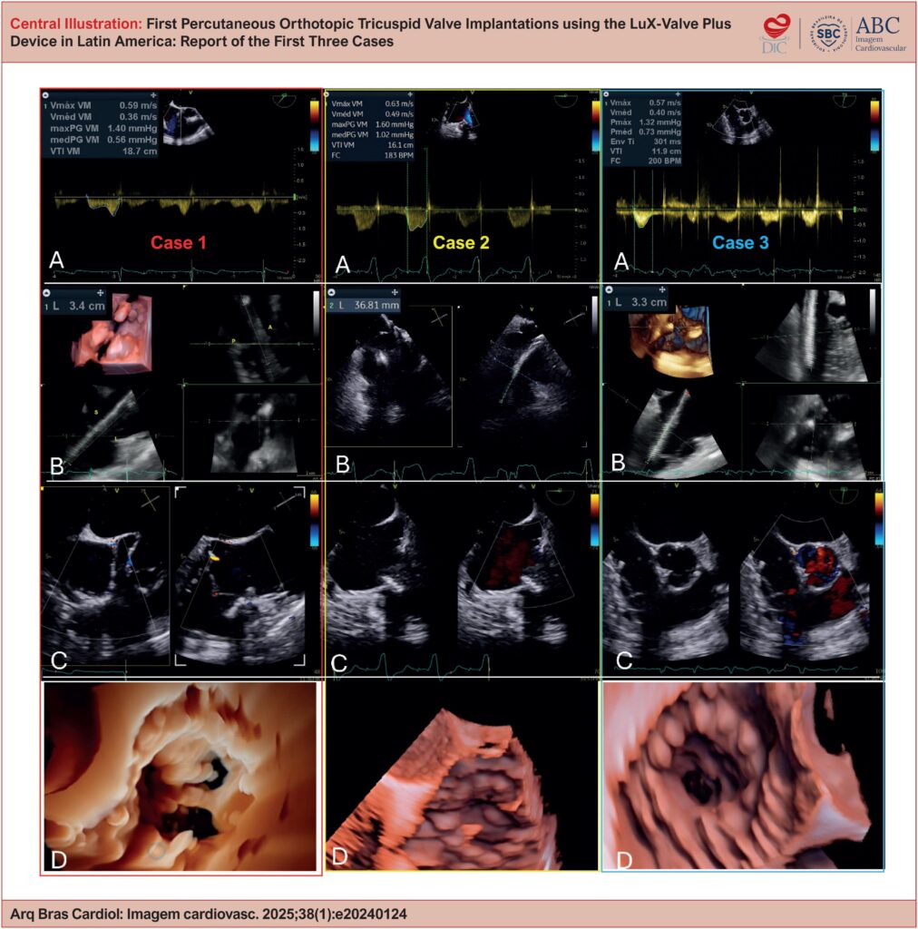 Echocardiographic assessment after LuX-Valve Plus implantation in the 3 cases, illustrating the following: (A) the mean gradient, (B) the positioning of the delivery system, (C) the resolution of TR, and (D) 3-dimensional reconstructions of the implanted valve, demonstrating the efficacy of the transcatheter approach.