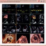 Echocardiographic assessment after LuX-Valve Plus implantation in the 3 cases, illustrating the following: (A) the mean gradient, (B) the positioning of the delivery system, (C) the resolution of TR, and (D) 3-dimensional reconstructions of the implanted valve, demonstrating the efficacy of the transcatheter approach.