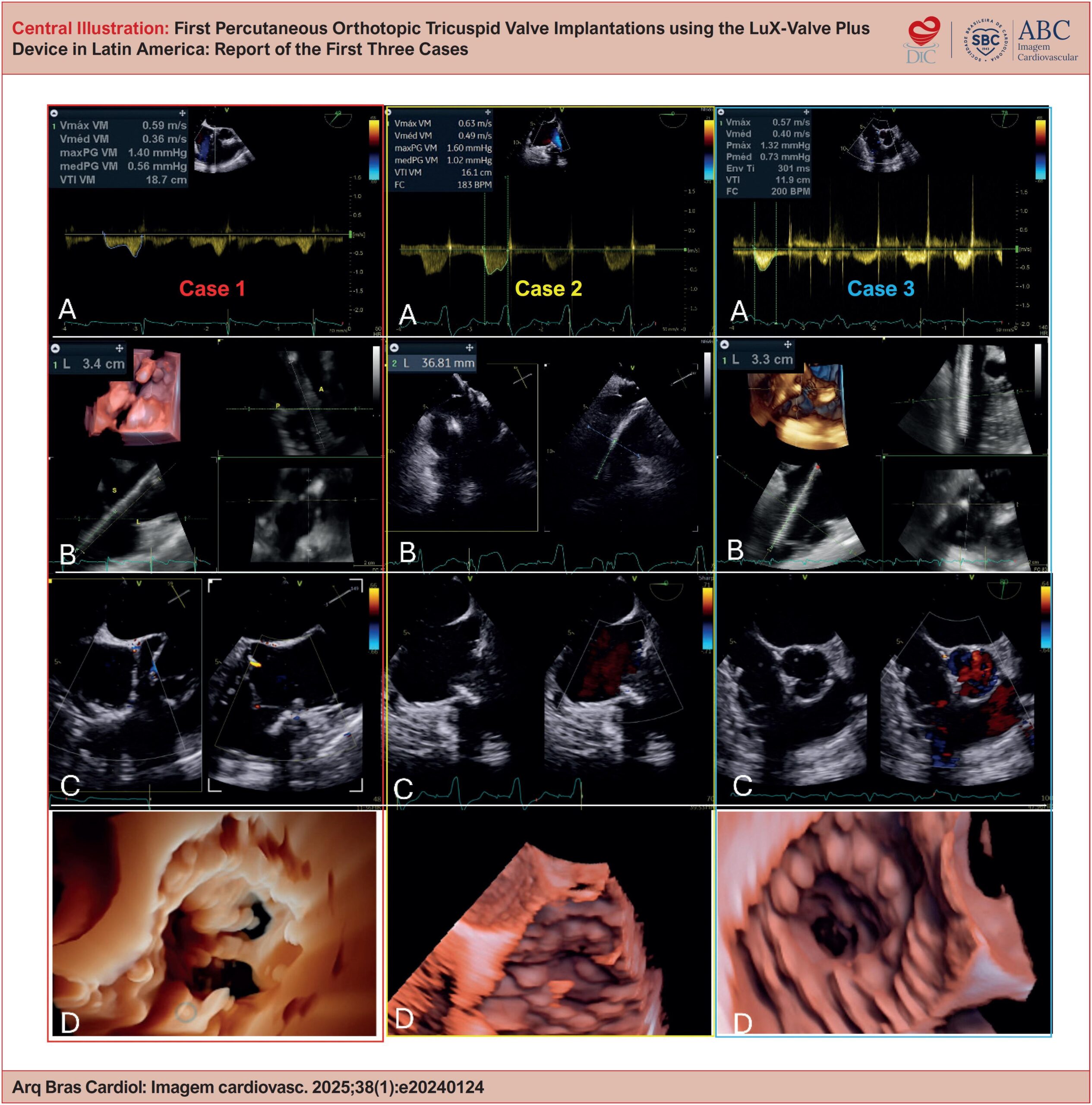 First Percutaneous Orthotopic Tricuspid Valve Implantations using the LuX-Valve Plus Device in Latin America: Report of the First Three Cases