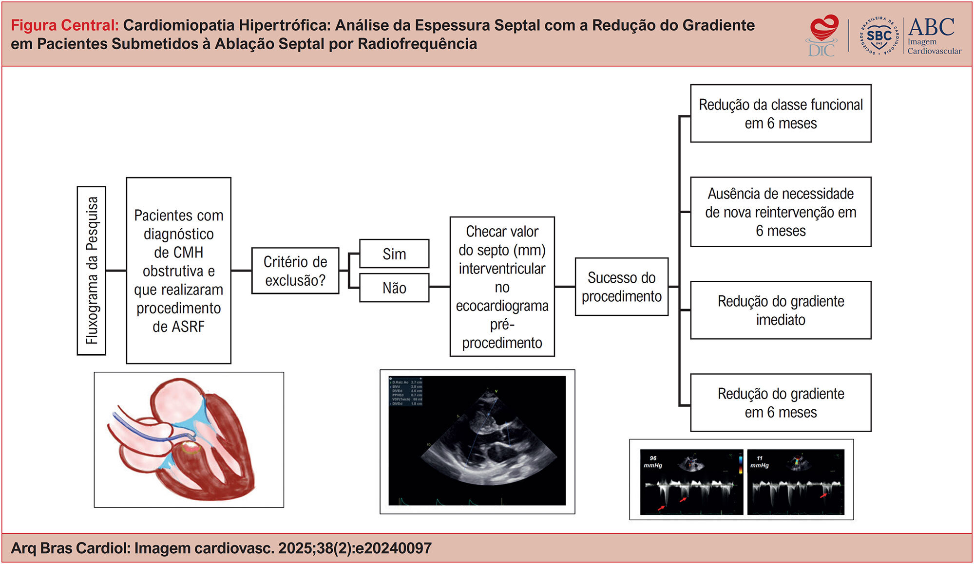 Cardiomiopatia Hipertrófica: Análise da Espessura Septal com a Redução do Gradiente em Pacientes Submetidos à Ablação Septal por Radiofrequência