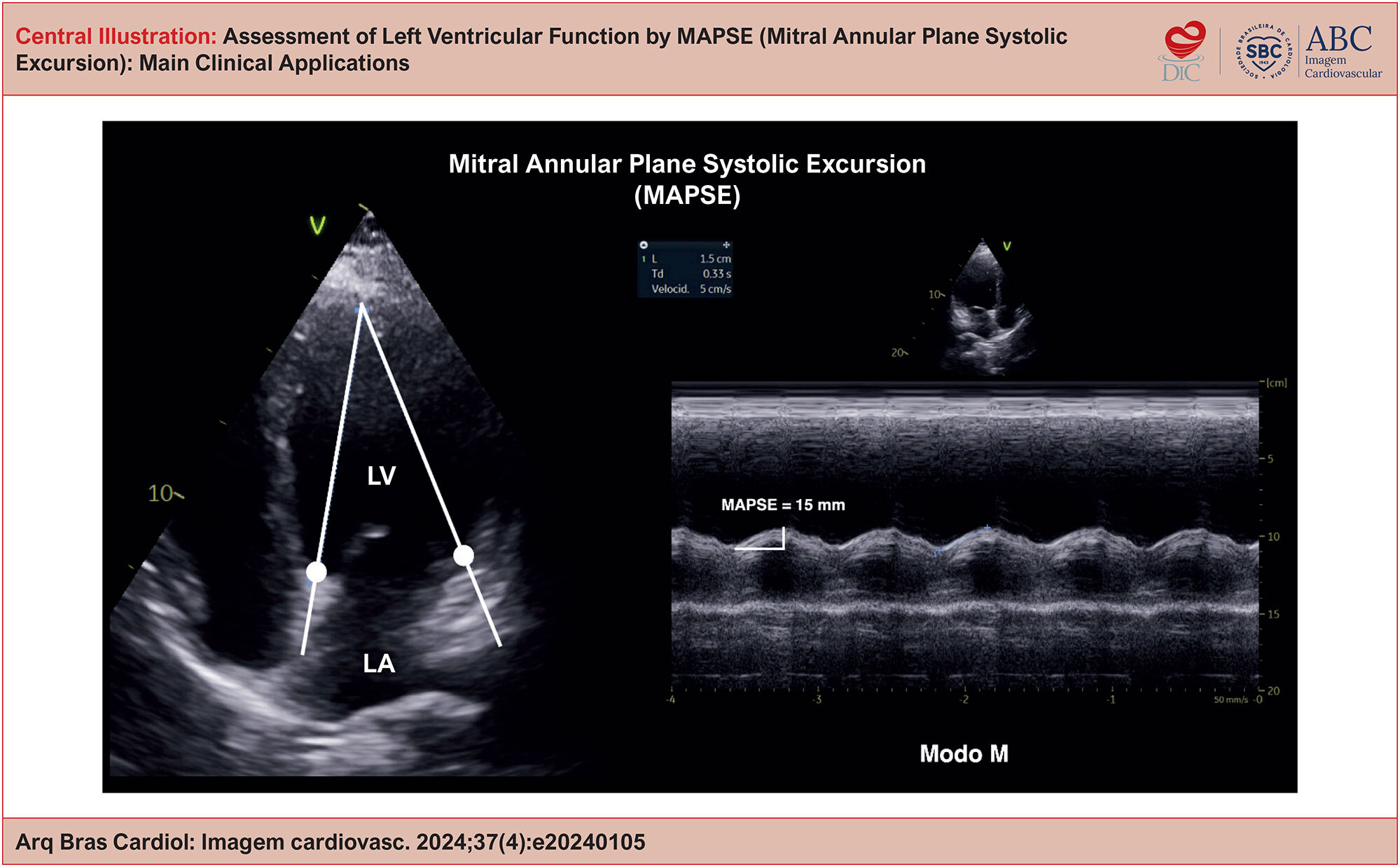 Assessment of Left Ventricular Function by MAPSE (Mitral Annular Plane Systolic Excursion): Main Clinical Applications
