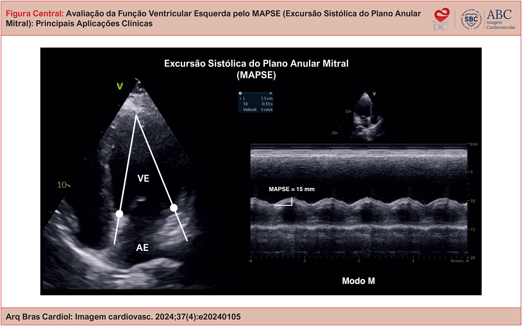 Avaliação da Função Ventricular Esquerda pelo MAPSE (Excursão Sistólica do Plano Anular Mitral): Principais Aplicações Clínicas