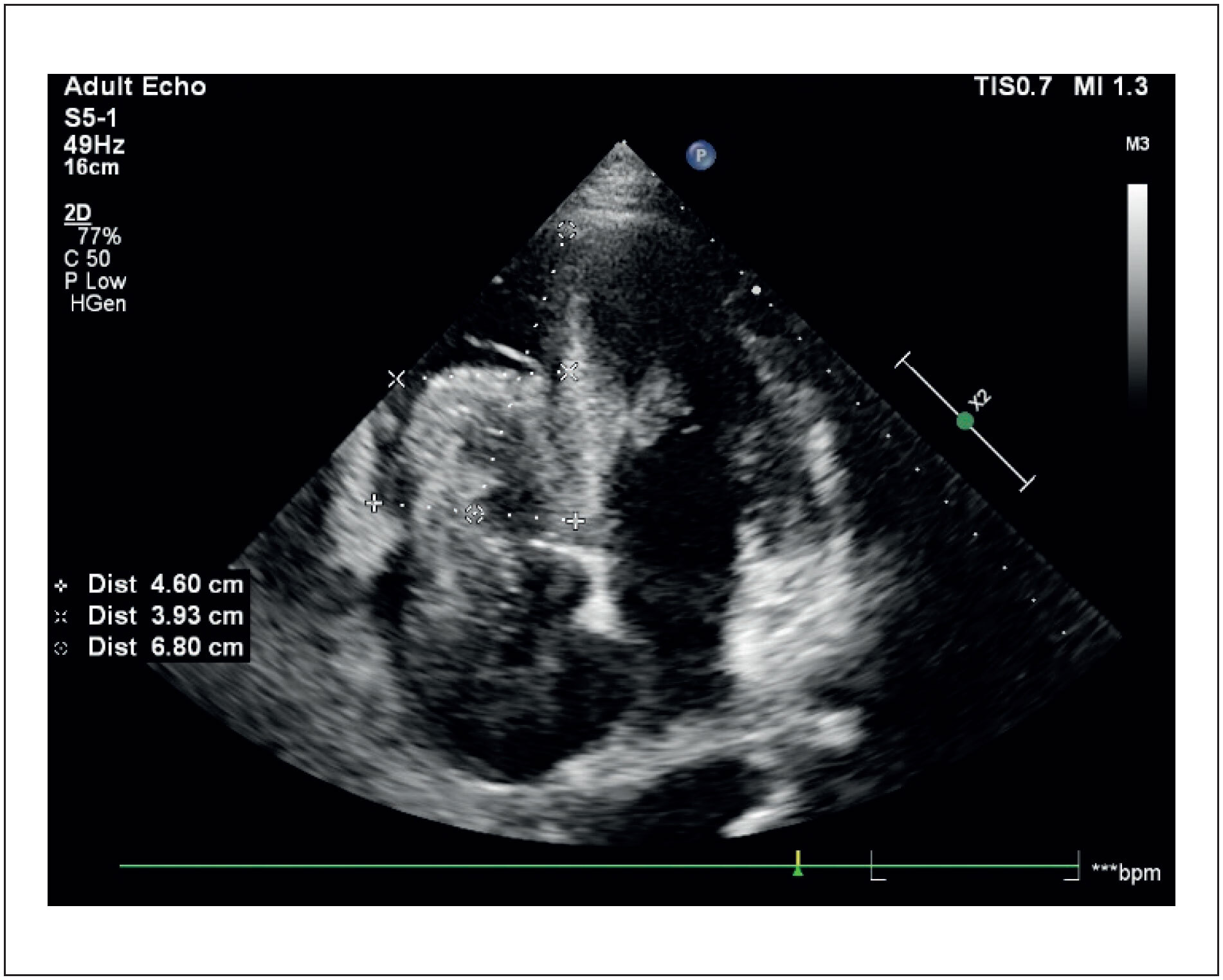 Volumosa Massa Heterogênea em Câmaras Direitas: Relato de Caso em Cardio-Oncologia