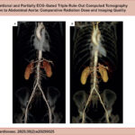 Three-dimensional volume-rendering CTA reconstructions of the same patient showing no significant difference in the overall image quality between fully (A) and partially (B) ECG-gated TRO scans.
