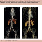 Reconstruções tridimensionais de ATC com renderização de volume do mesmo paciente, mostrando ausência de diferença significativa na qualidade geral da imagem entre os exames com TRO totalmente (A) e parcialmente (B) sincronizados ao ECG.