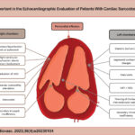 Main echocardiographic findings in sarcoidosis. RV: right ventricle; RV GLS: right ventricle global longitudinal strain; LVEF: left ventricle ejection fraction.