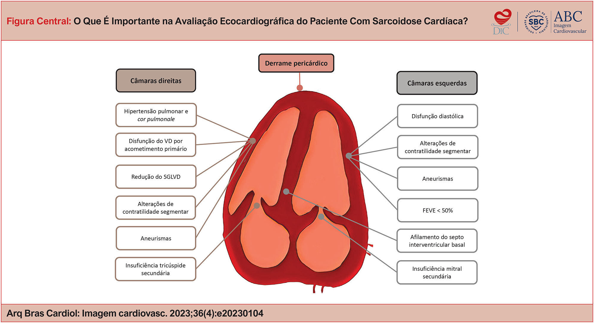 O Que É Importante na Avaliação Ecocardiográfica do Paciente Com Sarcoidose Cardíaca?