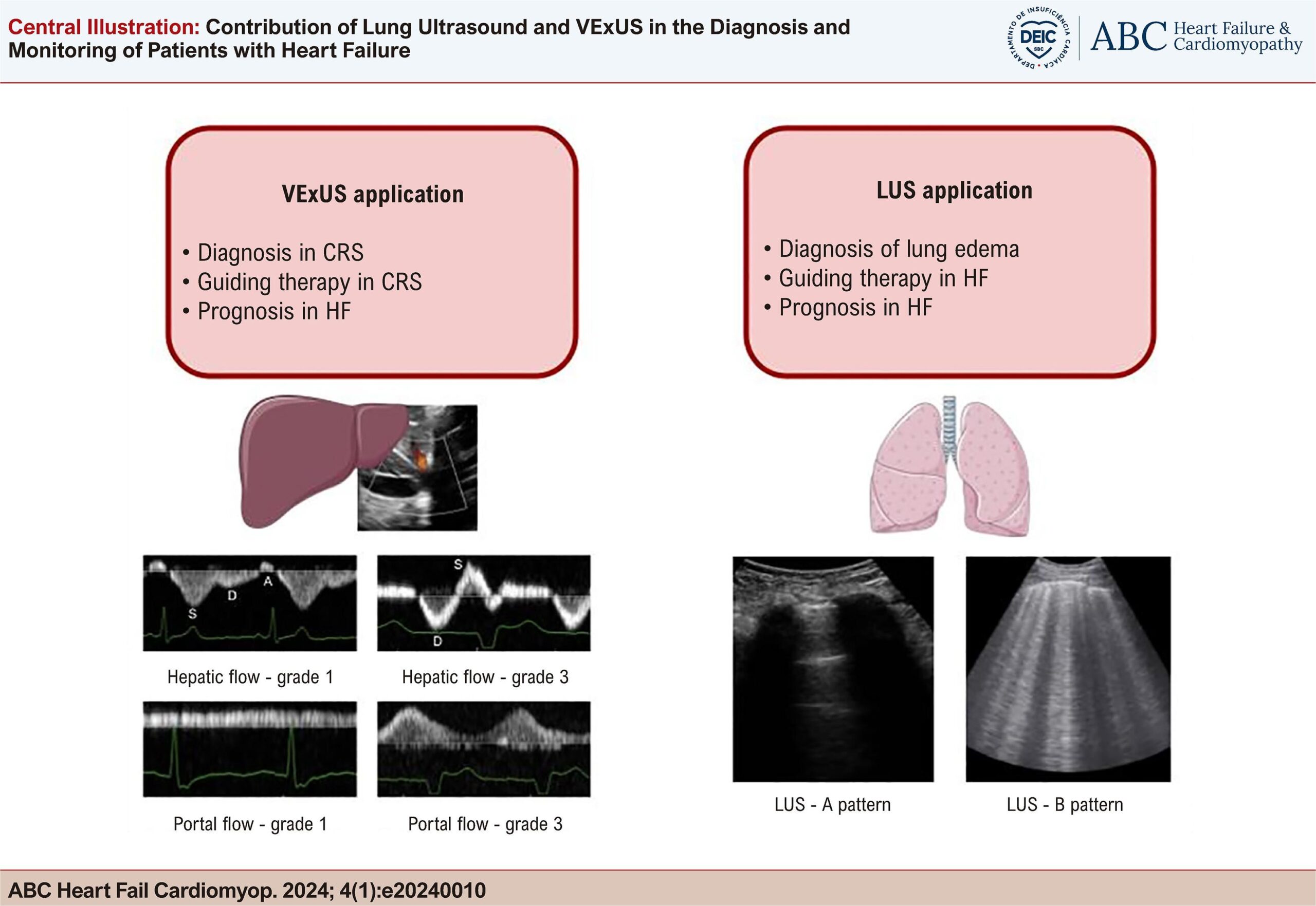 Contribution of Lung Ultrasound and VExUS in the Diagnosis and Monitoring of Patients with Heart Failure